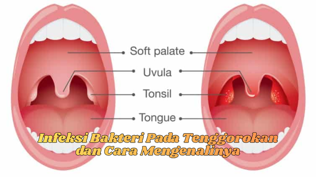 Infeksi Bakteri Pada Tenggorokan