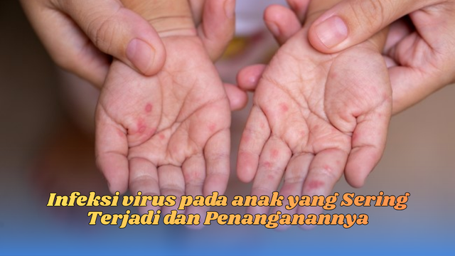 Infeksi Virus Pada Anak